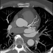 CT Calcium Score – 3D and Quantitative Imaging Laboratory
